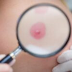 Retirer un grain de beauté : quand et pourquoi consulter ?