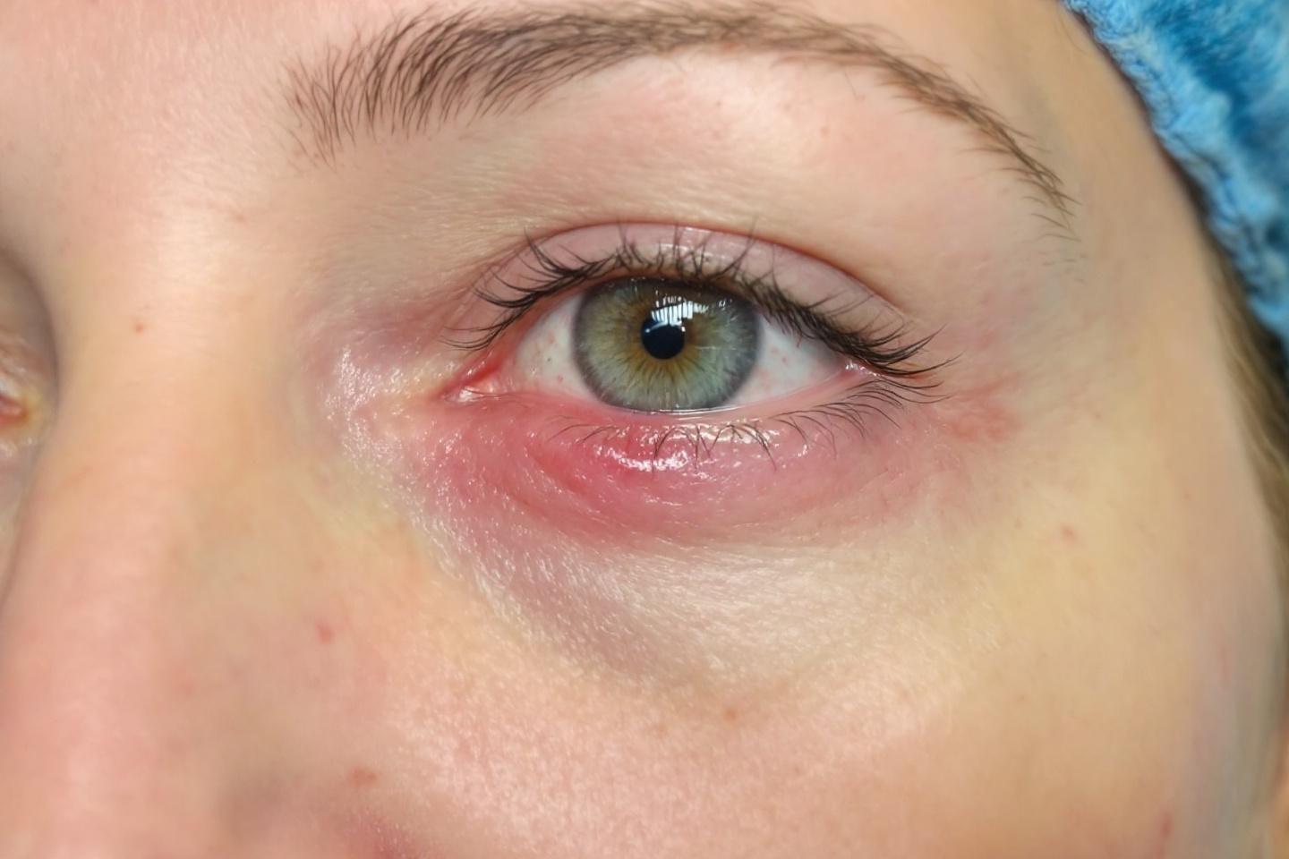 Injection acide hyaluronique lèvres Montpellier : tarifs et déroulé